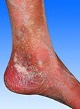 A lábszárfekély tünetei